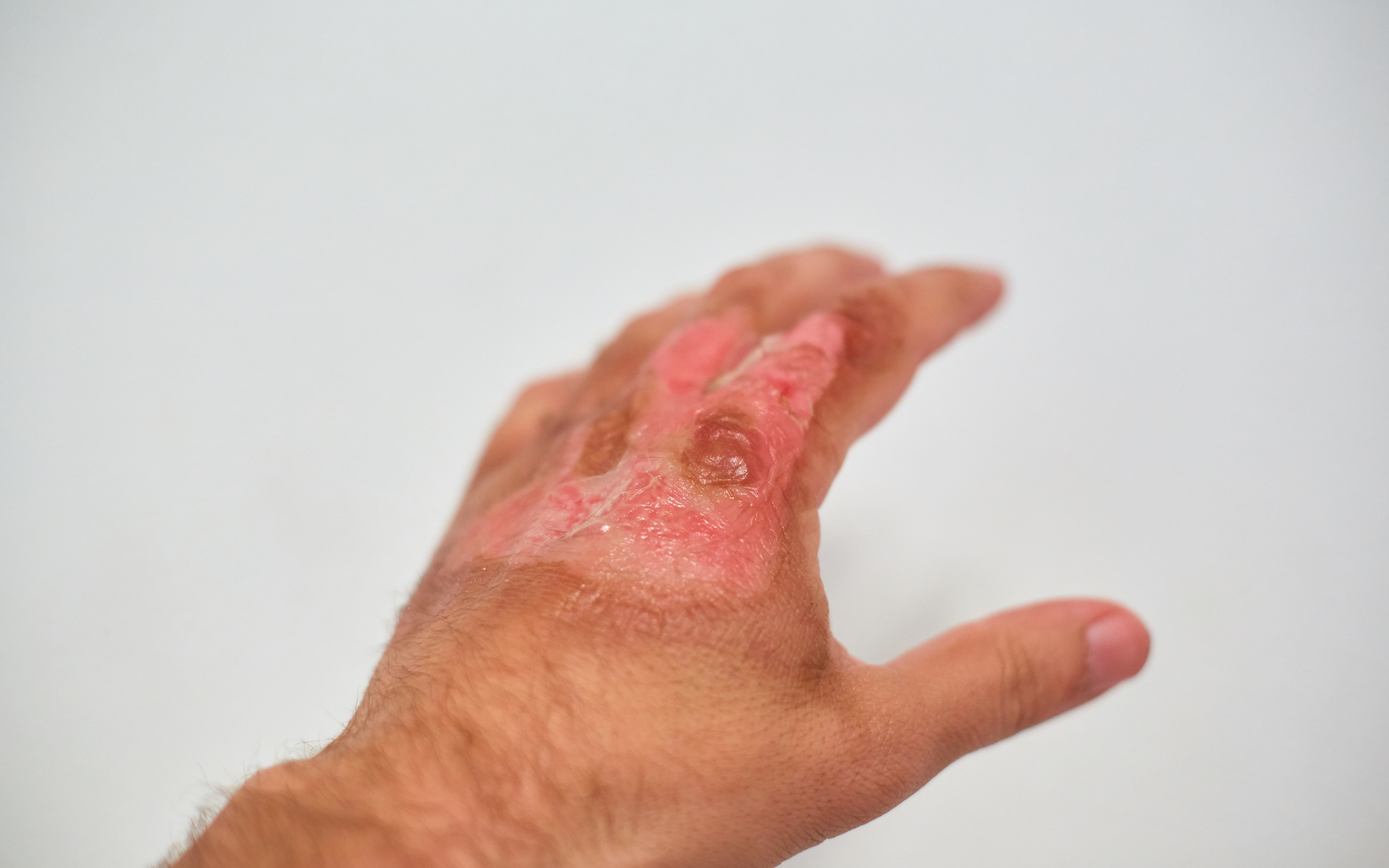 Burn Injury Lawyer Fort Mill, SC